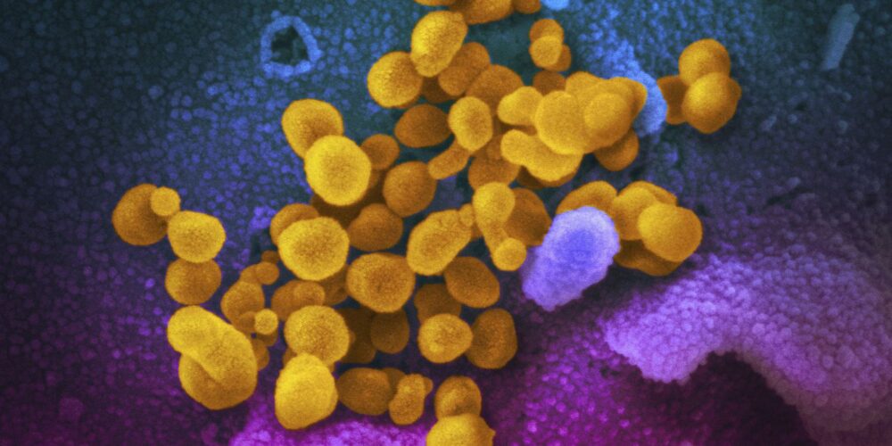 This undated electron microscope image made available by the U.S. National Institutes of Health in February 2020 shows the Novel Coronavirus SARS-CoV-2, yellow, emerging from the surface of cells, blue/pink, cultured in the lab. Also known as 2019-nCoV, the virus causes COVID-19. The sample was isolated from a patient in the U.S. (NIAID-RML via AP)